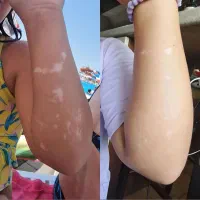 درمان مشکلات پیسی و پسوریازیس|آرایشی، بهداشتی، درمانی|اهواز, غیزانیه|دیوار