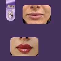 بوتاکس رایگان|خدمات آرایشگری و زیبایی|همدان, |دیوار