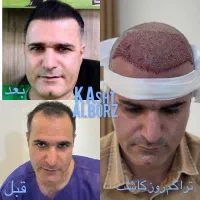 جشنواره کاشت ابرو و کاشت موی تخصصی
