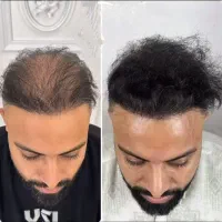با میکرو اسکالپ فقط در ۳ جلسه موهاتو پر پشت کن