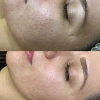 میکرونیدلینگ پوست صورت و بدن