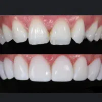 ونیر کامپوزیت، ترمیم، عصبکشی