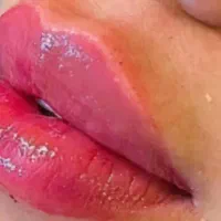 تزریق تخصصی ژل،چربی،بوتاکس،هایفوتراپی،لیزرمو