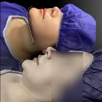 ساکشن غبغب|خدمات آرایشگری و زیبایی|یاسوج, |دیوار