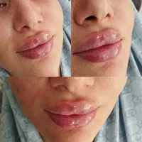 تخفیف ویژه ژل و فیلر|خدمات آرایشگری و زیبایی|گلبهار, شهر جدید گلبهار|دیوار