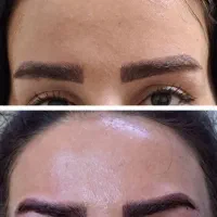 مطب پوست موزیبایی لیزرحذف تتوبالیزرQsبا۱۷سال تجربه
