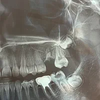 عصب کشی دندان ۶ و ۷ ( اسیاب بزرگ )