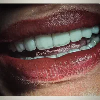 دندانپزشکی زیبایی و لمینت|خدمات آرایشگری و زیبایی|تهران, سلیمانی|دیوار