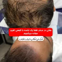 میکرواسکالپ فی اسکالپ سر|خدمات آرایشگری و زیبایی|شیراز, ملاصدرا|دیوار