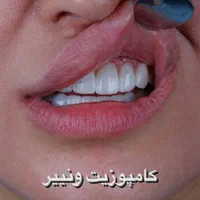 کامپوزیت ونیر لمینیت  عصب کشی ترمیم روکش ایمپلنت|خدمات آرایشگری و زیبایی|تهران, تهرانپارس شرقی|دیوار