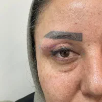 برداشت افتادگی پلک بالا و پایین