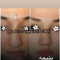 لیزرمیکرو پلاسمالیفت زیبایی/ بینی شیک/بلفاروپلاستی|خدمات آرایشگری و زیبایی|کرمانشاه, |دیوار