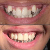 دندانپزشکی تخصصی ارتودنسی(مرتب کردن دندان ها) قسطی|خدمات آرایشگری و زیبایی|اهواز, شهرک حفاری|دیوار