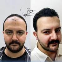 کاشتمو سوپرترکیبی تحت نظر پزشک متخصص|خدمات آرایشگری و زیبایی|سنندج, |دیوار