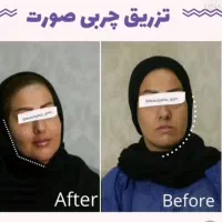تخفیف ساکشن شکم پهلو و پشت/ هر ناحیه از بدن/بلفارو|خدمات آرایشگری و زیبایی|قم, زنبیل آباد|دیوار