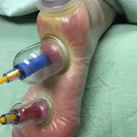 بادکش گرم و آگنی کارما.