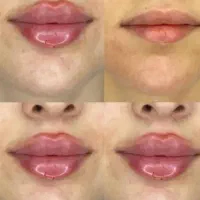 ژل بوتاکس مزو