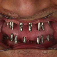 مرکز تخصصی ایمپلنت دیجیتال شرق تهران|خدمات زیبایی و سلامت|تهران, مشیریه|دیوار
