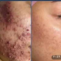 فشیال پاکسازی آموزش تخصصی درمانی همراه مدرک|خدمات آموزشی|تهران, سلسبیل جنوبی|دیوار