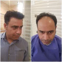 کاشت مو تضمینی واقساط|خدمات آرایشگری و زیبایی|اصفهان, محمودیه|دیوار