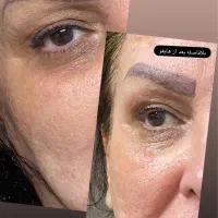 هایفوتراپی و فشیال پوست کره ای|خدمات آرایشگری و زیبایی|یزد, |دیوار