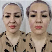 هایفو سفت لیفت کننده پوست صورت وغبغب ۸۹۰ت اصفهان