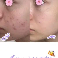 پاکسازی پوست با قیمت و کیفیت مناسب