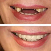 تخفیف ایمپلنت کره ای  تضمینی با روکش زیرکونیا