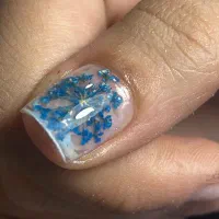 کاشت متد جدید اولین بار در زنجان