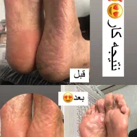 پدیکور پا ،رفع تیرگی ،قوزک پا|خدمات آرایشگری و زیبایی|پاکدشت, پاکدشت (مامازند)|دیوار