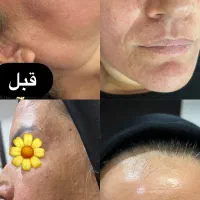 جشنواره زیبایی پوست با هایفوتراپی و آر اف فرکشنال|خدمات آرایشگری و زیبایی|قم, دورشهر|دیوار