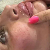 ژل و بوتاکس