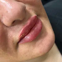 تزریق فیلر و بوتاکس|خدمات آرایشگری و زیبایی|قرچک, مهدیه|دیوار