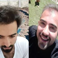 کاشت مو، ابرو، ریش توسط تکنسین15سال تجربه|خدمات آرایشگری و زیبایی|تهران, صادقیه|دیوار