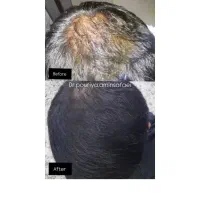 بوتاکس،فیلر،مزوژل باتخفیفی که نمی‌خوای از دست بدی|خدمات آرایشگری و زیبایی|شیراز, میرزاکوچک خان|دیوار