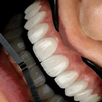 دندانپزشکی مجهز به بی حسی بدون درد دیجیتالی+اقساط|خدمات آرایشگری و زیبایی|خرم‌آباد, |دیوار