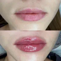 تزریق ژل بوتاکس مزو جوانساز|خدمات آرایشگری و زیبایی|وحیدیه, |دیوار