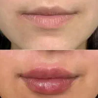 ترزیق ژل و بوتاکس،تخصصی و تضمینی|خدمات آرایشگری و زیبایی|نورآباد, |دیوار