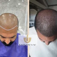 کاشت مو ۲۲ و کاشت ابرو ۱۵