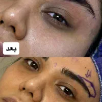 بلفارو پلک بالا.پایین..دایرکت آبرو ۸ م