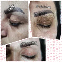 رفع افتادگی پلک بدون جراحی تضمینی