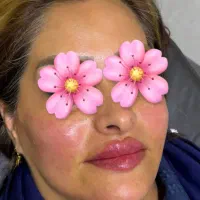 خدمات فیلربوتاکس اموزش جوانساز