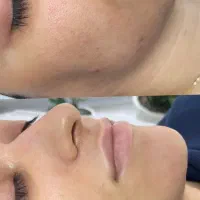 فیشیال تخصصی و درمانی پوست|خدمات آرایشگری و زیبایی|آمل, |دیوار