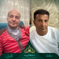 کاشت مو دکتر سارا سلطانی