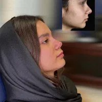 جراحی بینی با قیمت ویژه جشنواره