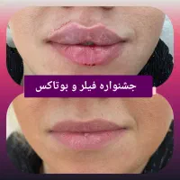 فیلر و بوتاکس|خدمات آرایشگری و زیبایی|ارومیه, |دیوار