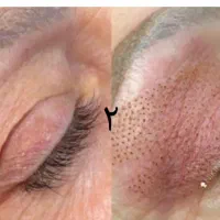 خدمات ریموو تتو صورت وجوانسازی صورت|خدمات آرایشگری و زیبایی|اصفهان, شهرک ولیعصر|دیوار