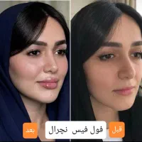 جشنواره/فیلر/بوتاکس/آنزیم/تخفیف دکترفیروزی|خدمات آرایشگری و زیبایی|شیراز, زرهی|دیوار