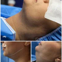 جشنواره ساکشن غبغب با تخفیف استثنایی