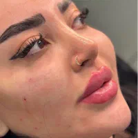 مدل بوتاکس و پی ار پی و کانتورینگ صورت با فیلر